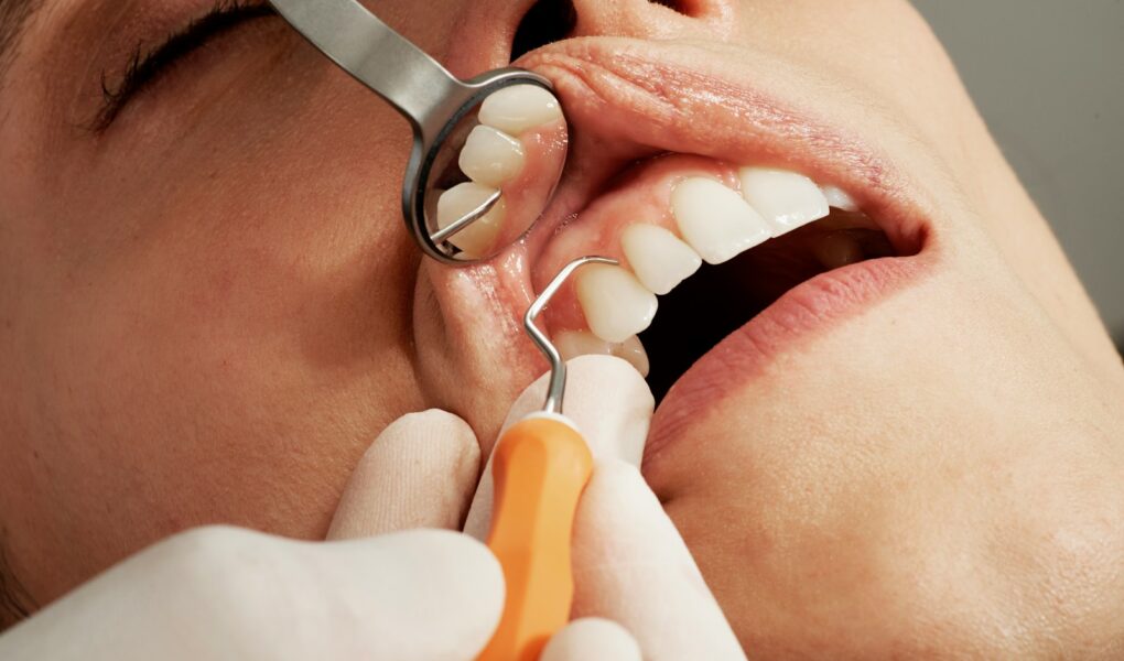 Qu'est-ce qu'un implant dentaire et comment ça marche
